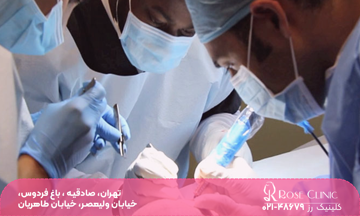 چند پزشک با ماسک و روپوش پزشکی که در اتاق عمل مشغول کاشت مو بر روی سر فرد هستند