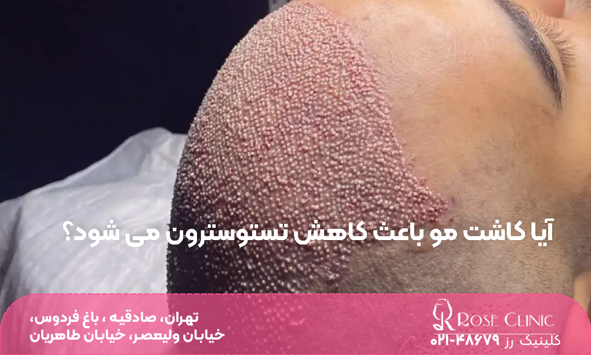 عکس از سر مردی که کاشت انجام داده است و روی تصویر نوشته شده آیا کاشت مو باعث کاهش تستوسترون می شود