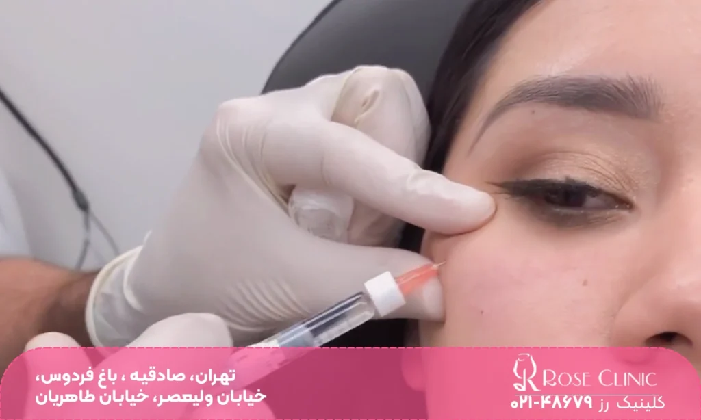 فردی که خوابیده و به سمت پایین نگاه می کند و دست دکتری که در حال تزریق ژل به زیر چشم فرد است - تزریق ژل زیر چشم