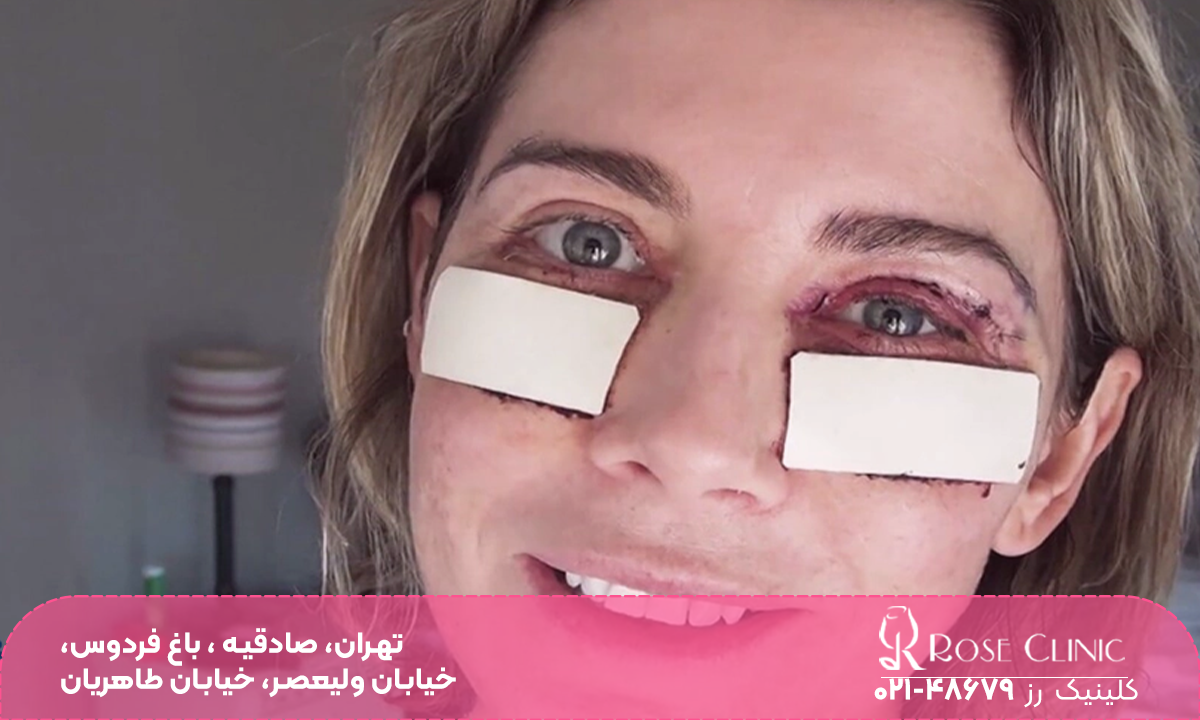دختری که بلفاروپلاستی پلک پایین انجام داده و چشم او ورم دارد