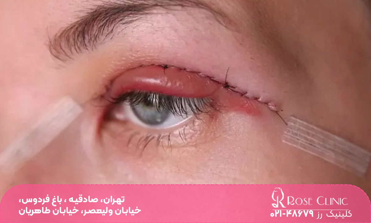 چشم فردی که بعد از عمل بلفاروپلاستی پشت پلکش قرمز شده و بخیه دارد