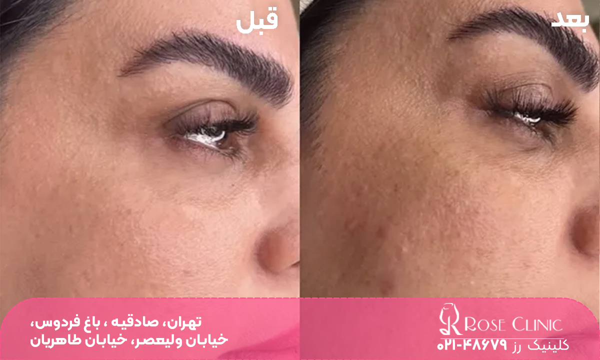 عکس قبل و بعد فردی که تزریق مزوژل پروسترولین انجام داده است