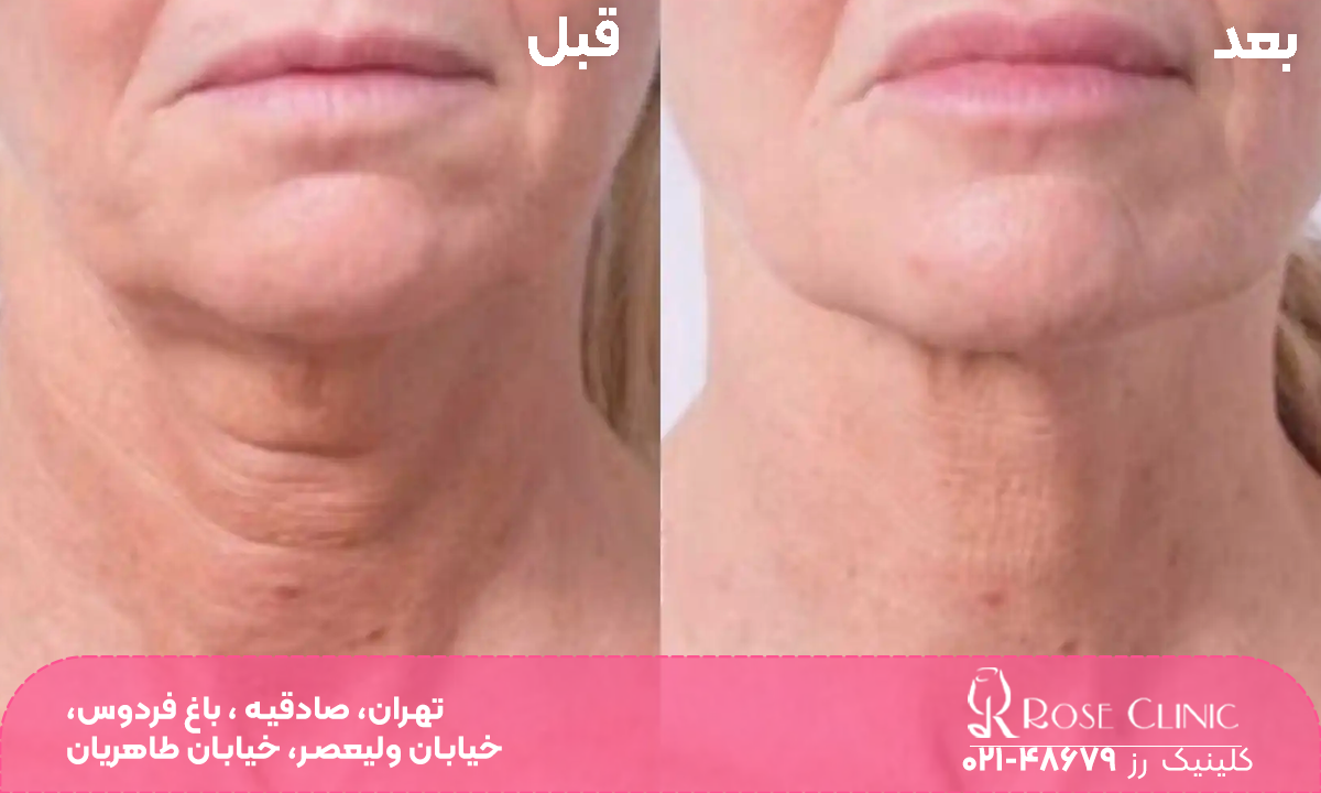 عکس قبل و بعد تزریق پروفایلو به غبغب و گردن زن که بعد از تزریق چروک های گردن او رفع شده است