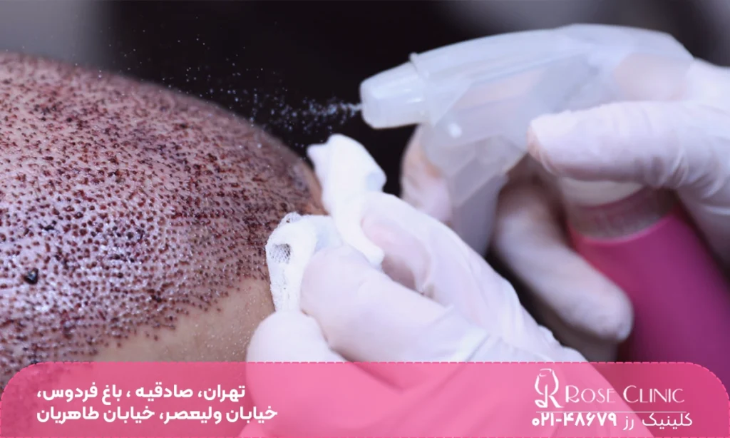 عکس از سر فردی که مو کاشته است و دستان فرد دیگری که رو به رویش است در حال اسپری کردن آب است - مراقبت های بعد از کاشت مو