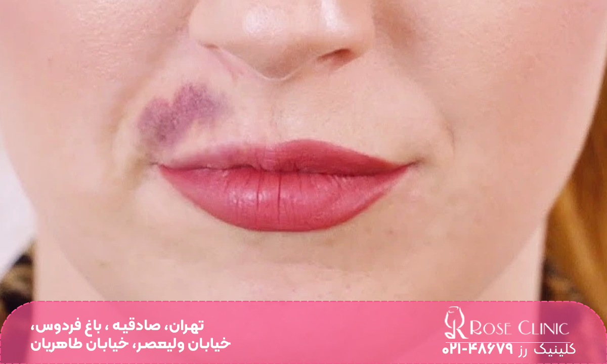 دختری که کنار لب او بعد از تزریق ژل خط خنده کبود شده است
