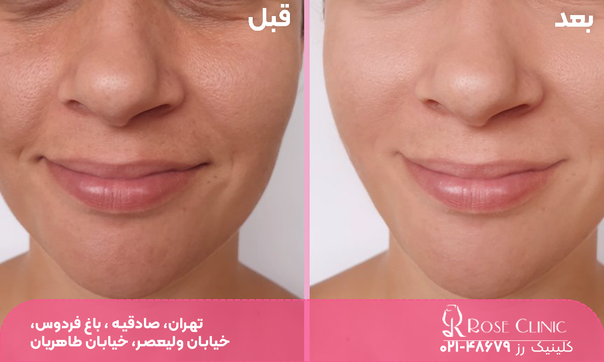 عکس قبل و بعد دختری که تزریق مزوژل انجام داده است و خطوط روی صورت او کم شده است