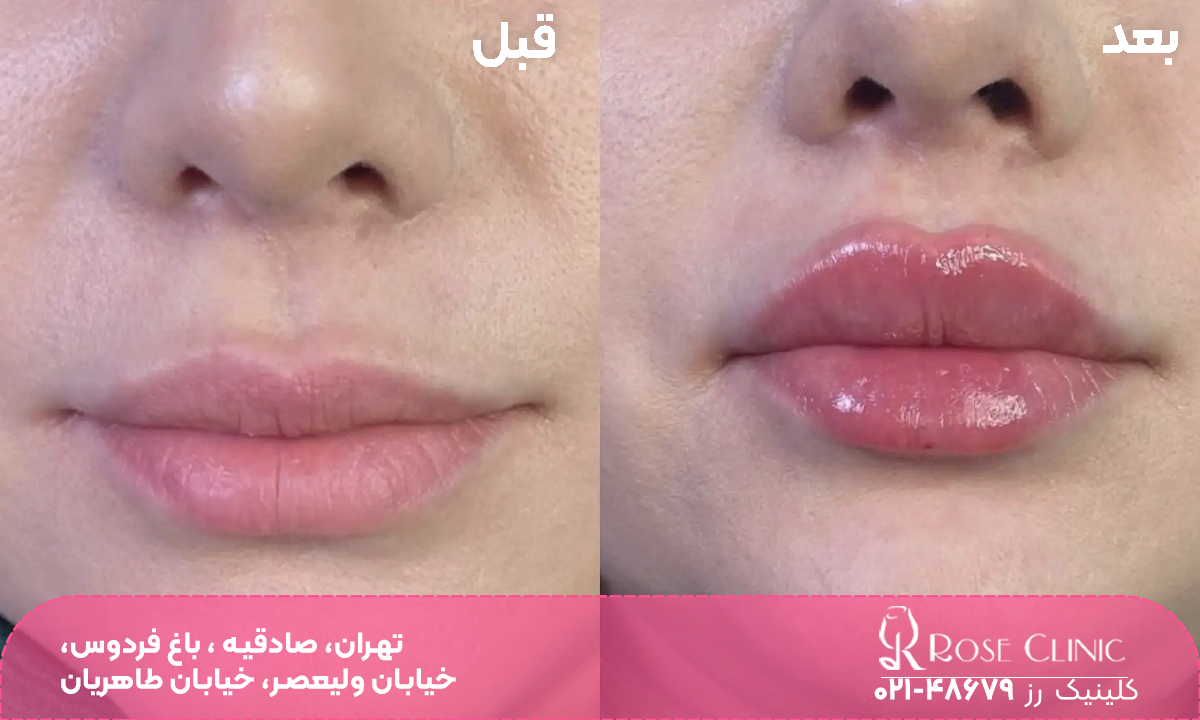 عکس قبل و بعد دختری که به لب خود ژل تزریق کرده است