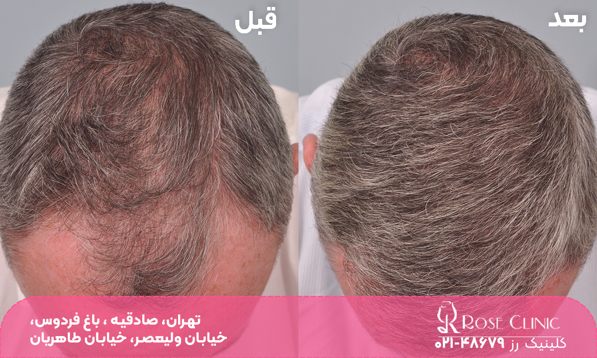 قبل و بعد فردی که کاشت مو انجام داده است
