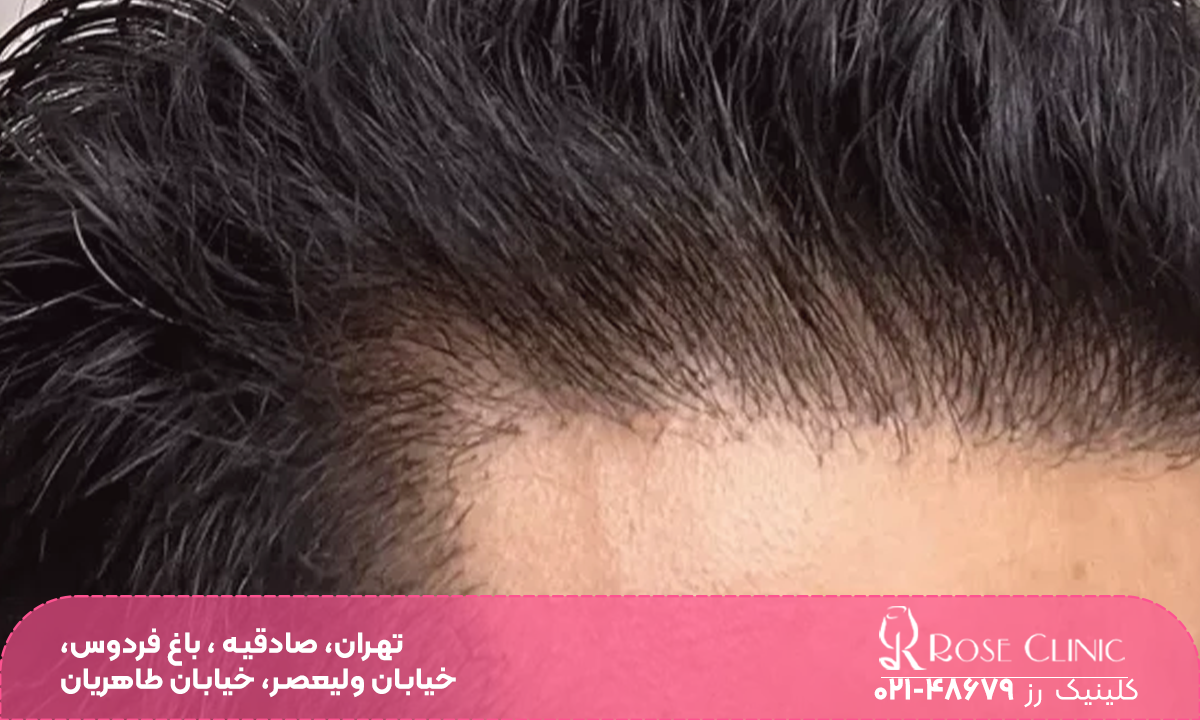 خط رویش موی مردی که موهای پرپشت و ضخیمی دارد