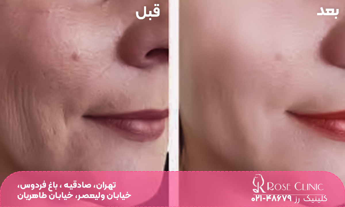 قبل و بعد فردی که مزوژل تزریق کرده است