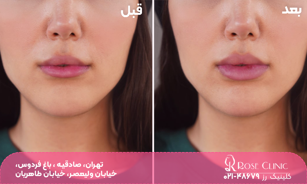قبل و بعد فردی که تزریق ژل خط خنده انجام داده است