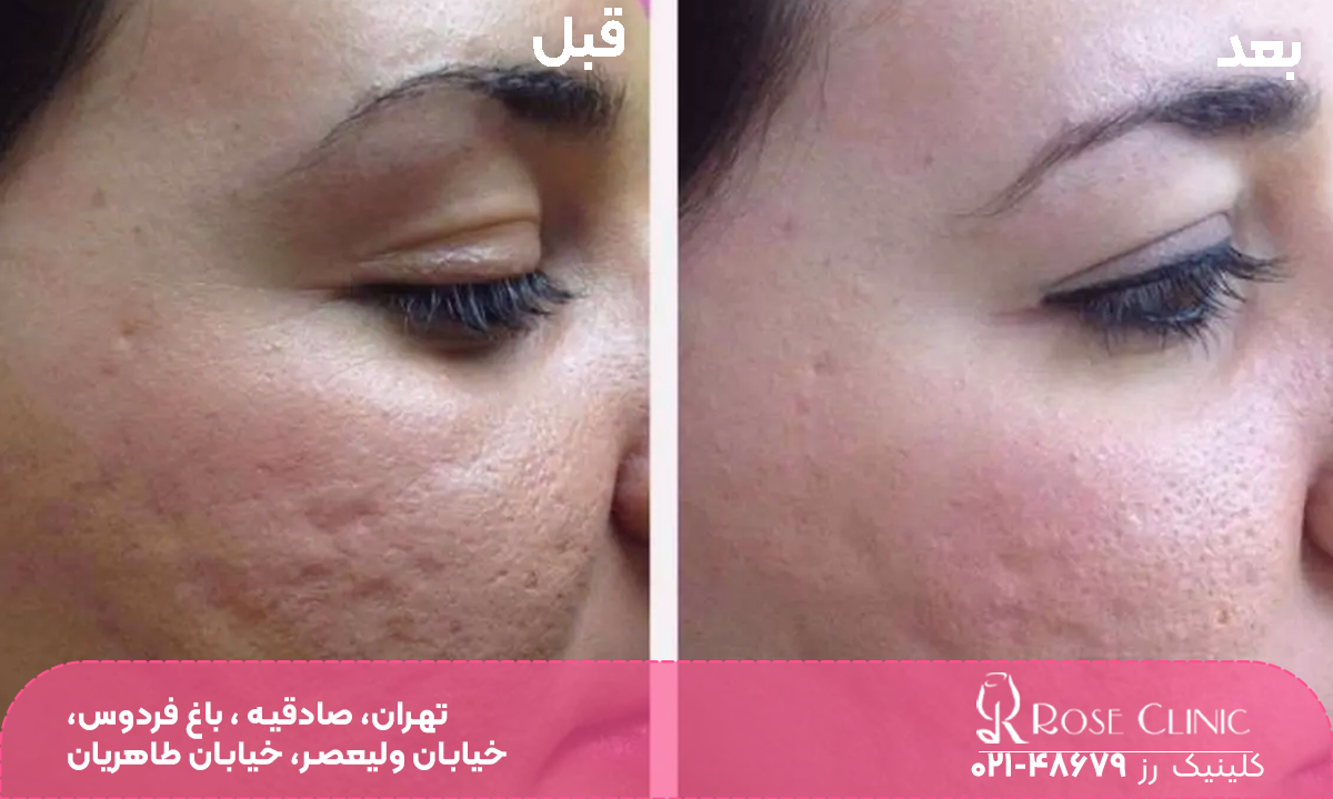 عکس قبل و بعد فردی که مزوتراپی انجام داده است