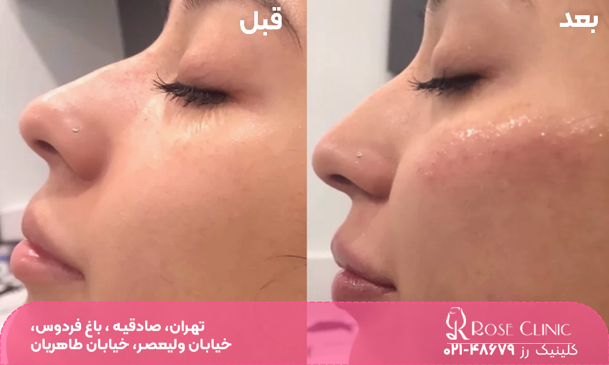 عکس قبل و بعد دختری که تزریق ژل گونه انجام داده است و گونه های او برآمده شده است