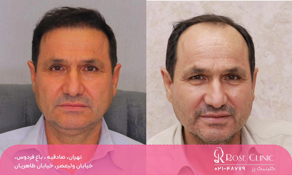 مرد میانسال مقایسه قبل و بعد کاشت مو