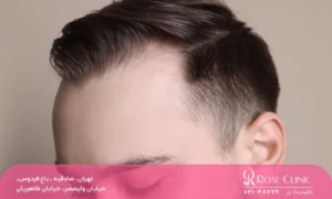 مردی که بعد 1 سال روند رشد موها تکمیل شده است