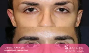 فردی بعد از مزوتراپی ابرو دارای ابروهای پرپشت است