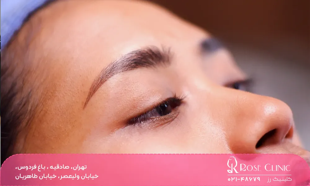 کاشت ابرو