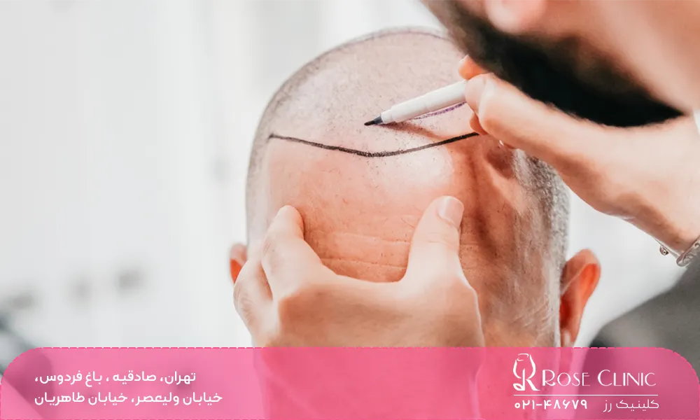 کاشت مو طبیعی یا مصنوعی؟