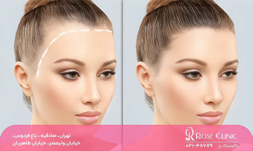 روش DHI و تفاوت آن با FUE در سرعت رشد