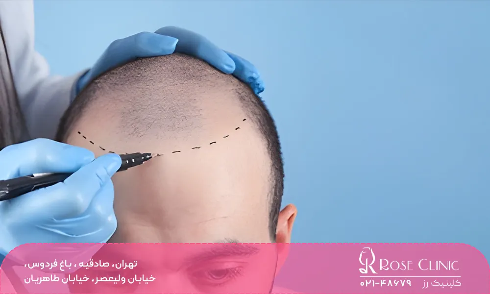 تفاوت سرعت رشد مو در روش‌ های مختلف کاشت