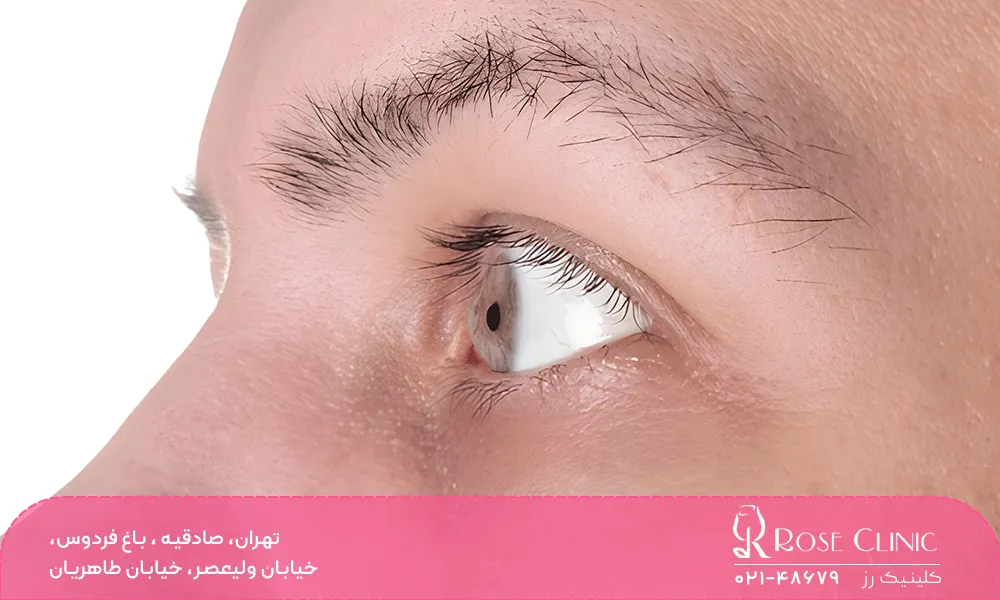 کمبود کدام ویتامین باعث ریزش ابرو میشود