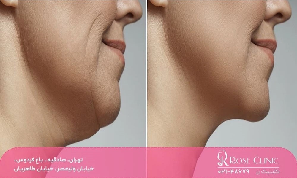 عکس قبل و بعد مزوتراپی غبغب