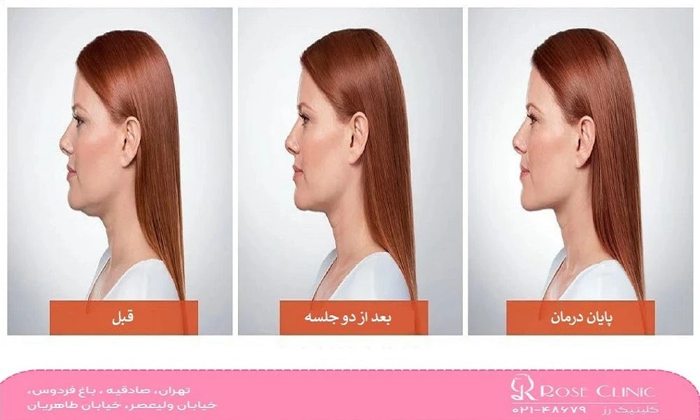 مراحل مزوتراپی