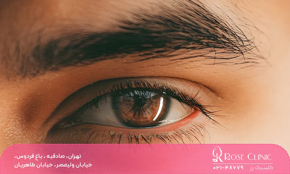 تفاوت تراکم ابرو در کاشت آقایان و خانم‌ها