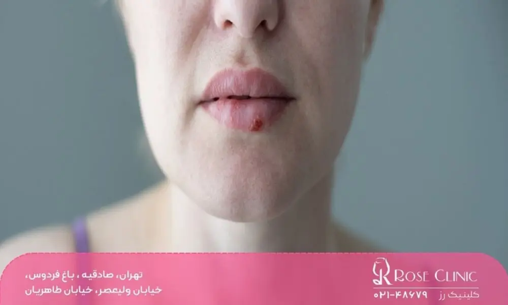 علائم عفونت لب بعد از تزریق ژل 