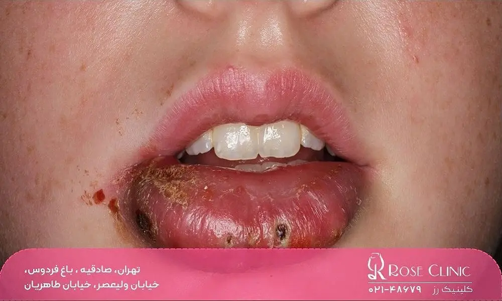 عفونت لب بعد از تزریق ژل