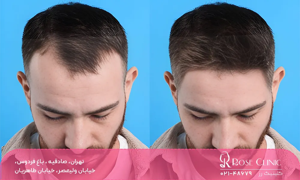 موهای کاشته شده کی در میاد