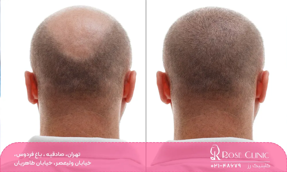 کاشت مو بدون بانک