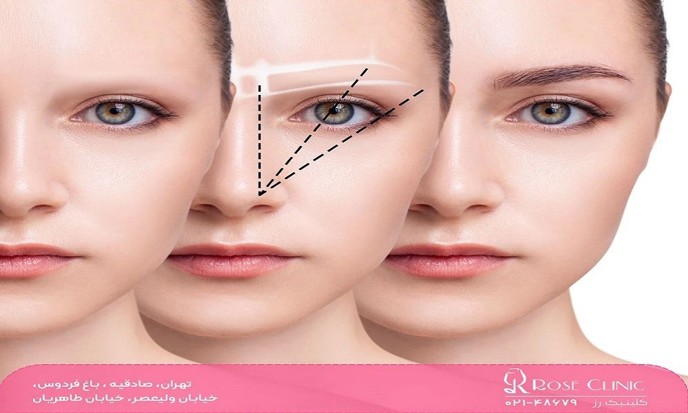 قبل از کاشت ابرو چه کنیم