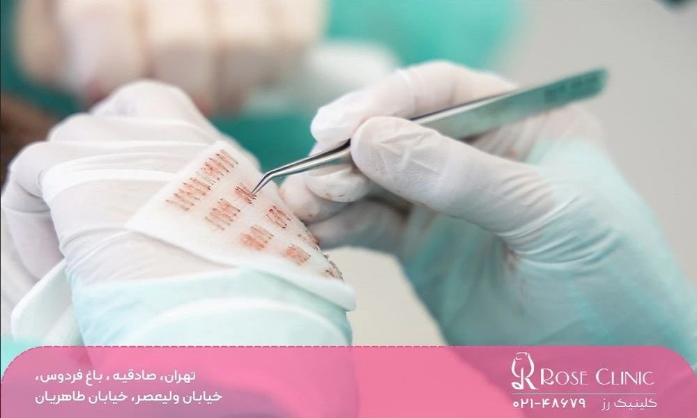 کاشت مو به روش bht