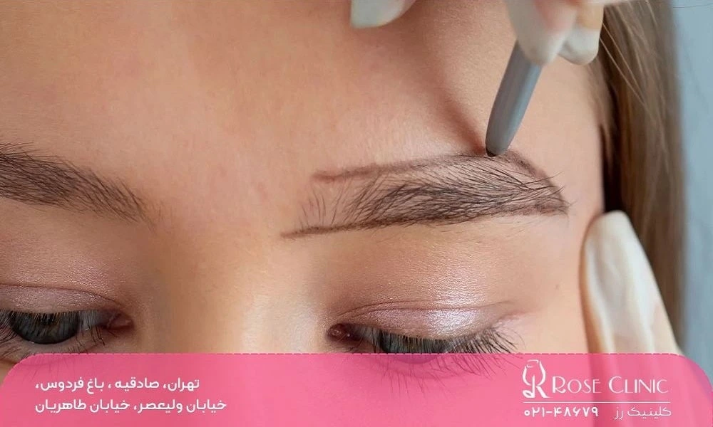 کاشت ابرو به روش DHI