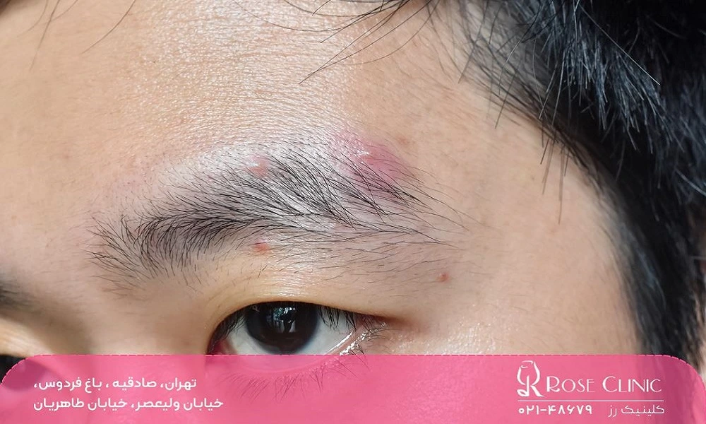 التهاب ابرو بعد از کاشت