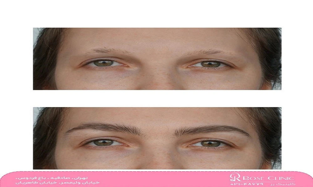 سیخ شدن ابرو بعد از کاشت