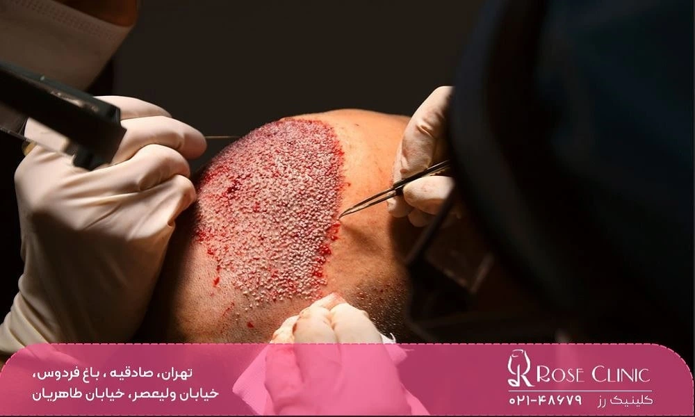 کاشت مو به روش fit