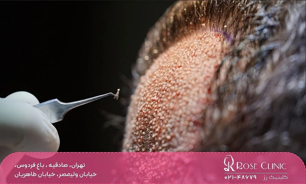 کاشت مو به روش fue