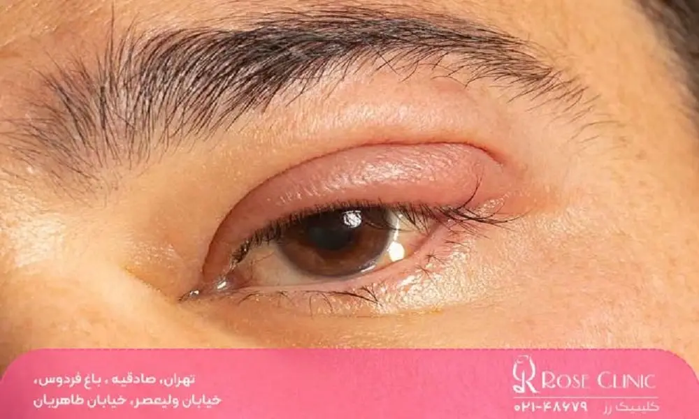 خارش یعد از کاشت ابرو