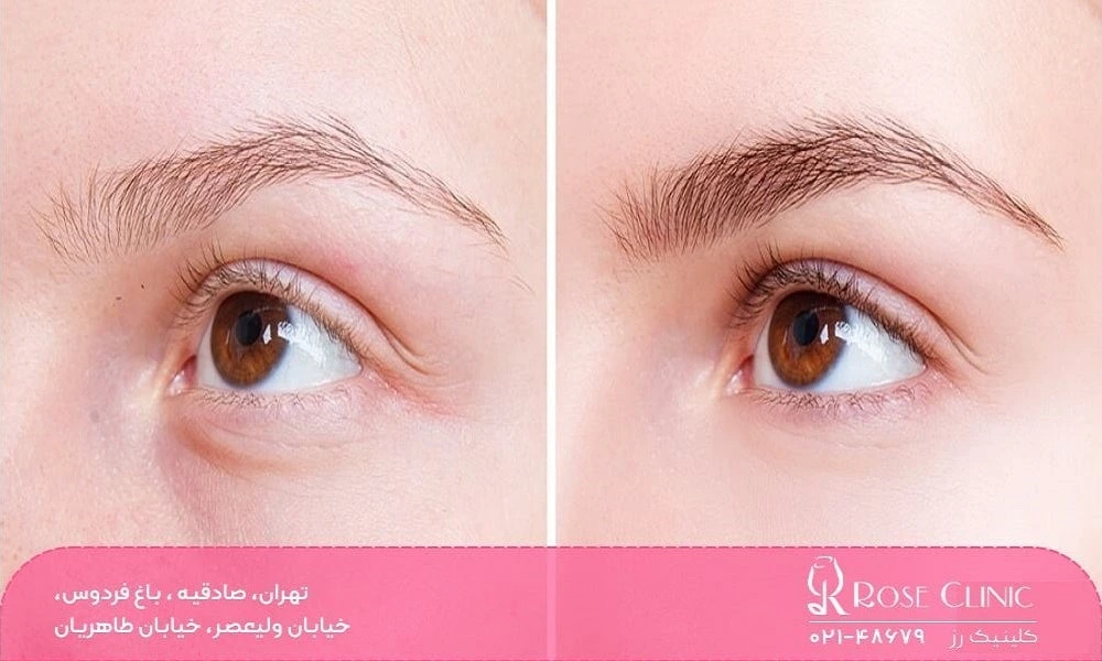 کاشت ابرو به روش SUT