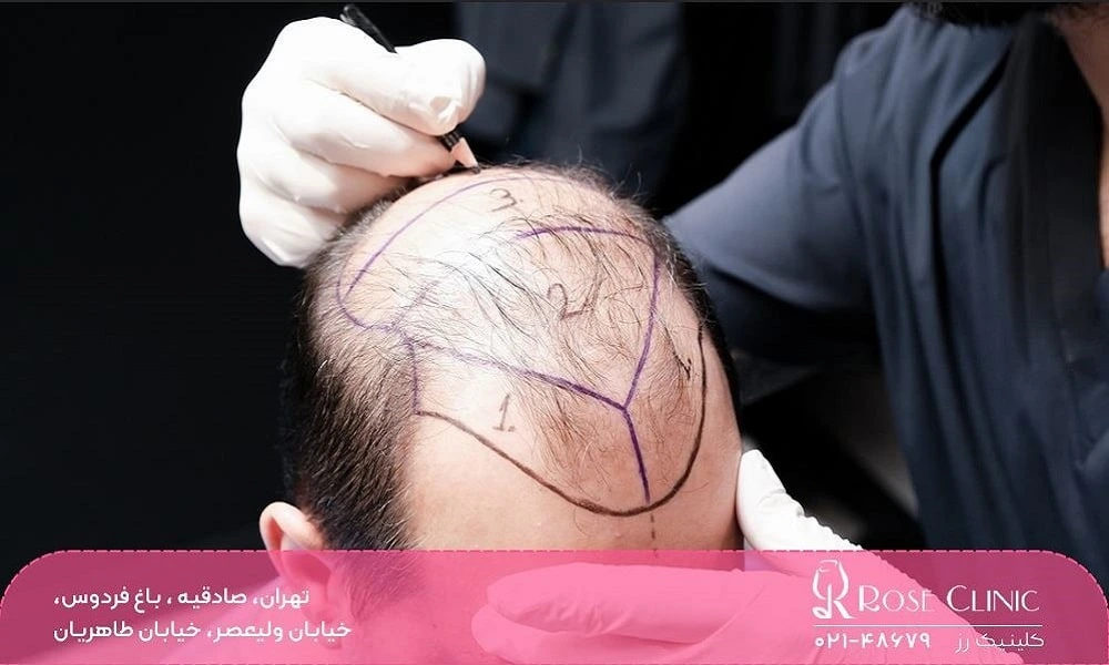 کاشت مو به روش sut