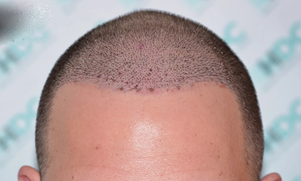 عکس جوش بعد از کاشت مو روی سر یک آقا