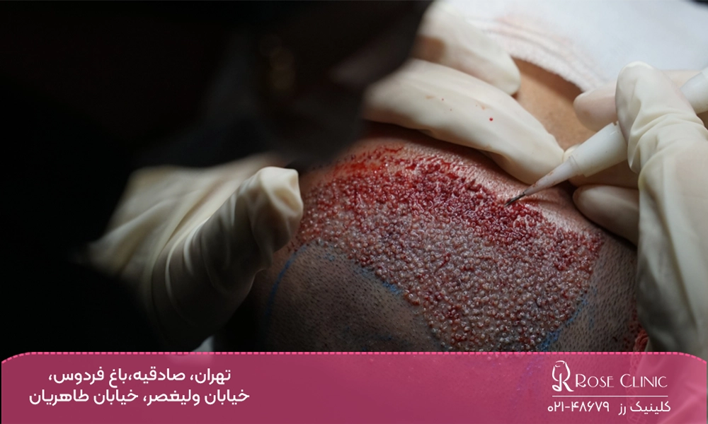 پزشک در حال انجام کاشت مو به روش نیوگرافت است.