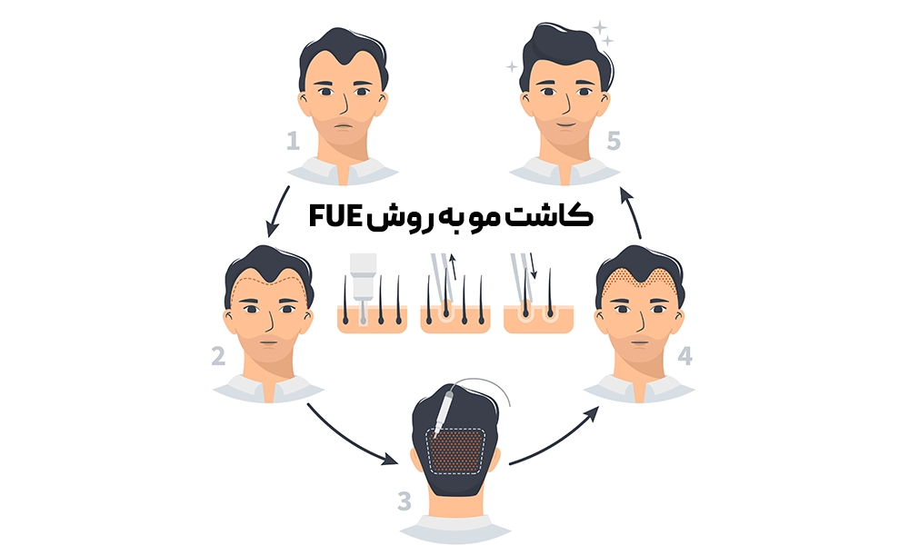 کاشت مو به روش fue
