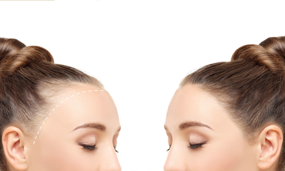 عکس کاشت مو جلو سر