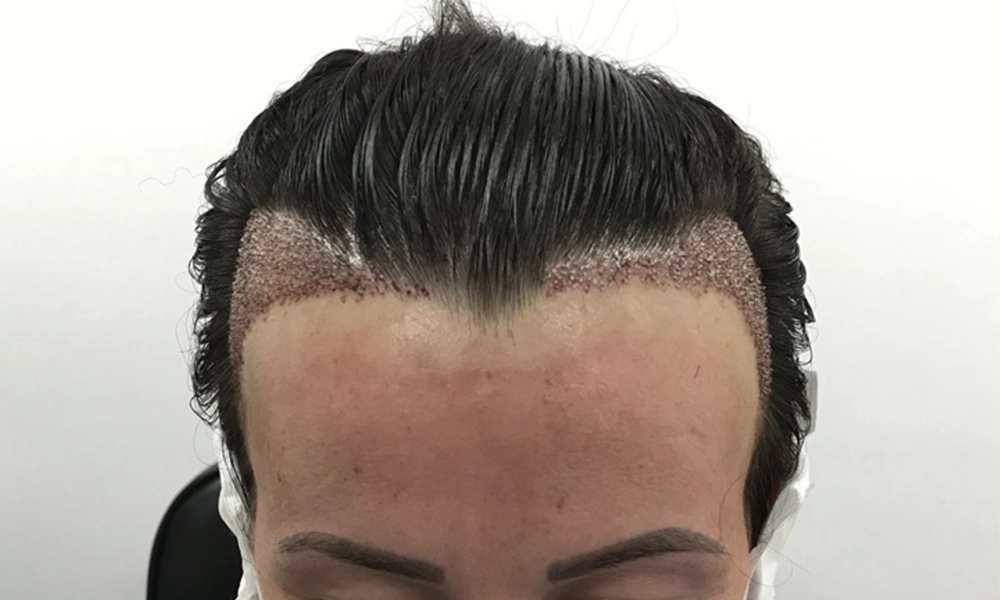 عکس کاشت مو بدون تراشیدن سر