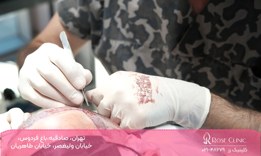 کاشت مو به روش نیوگرافت