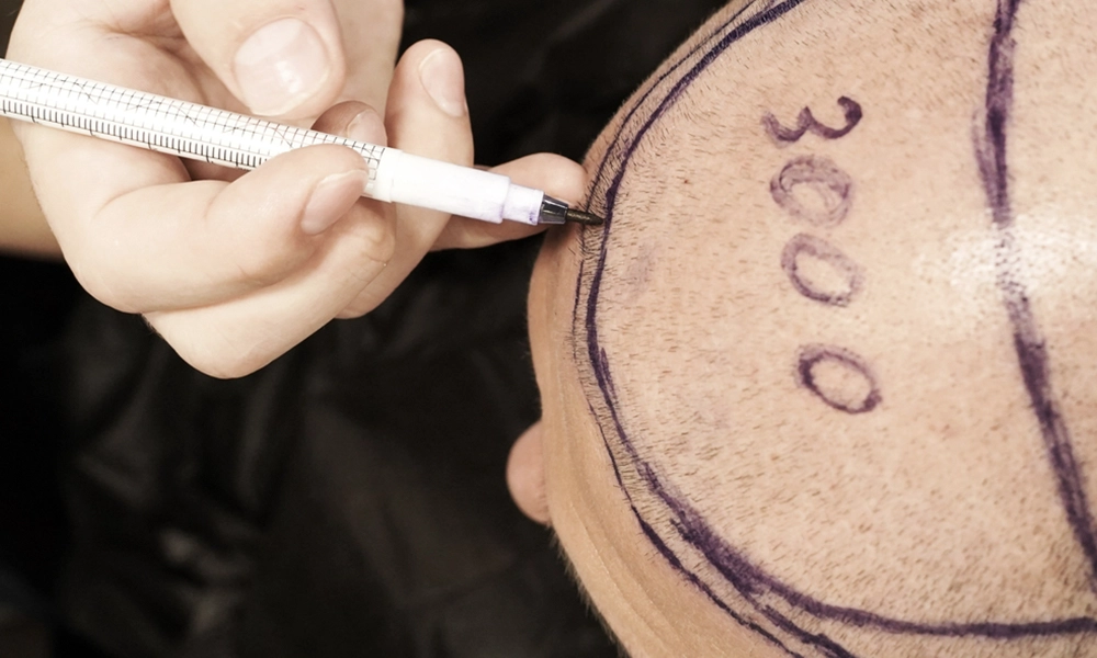 مشخص کردن ناحیه کاشت مو با الیاف نانو