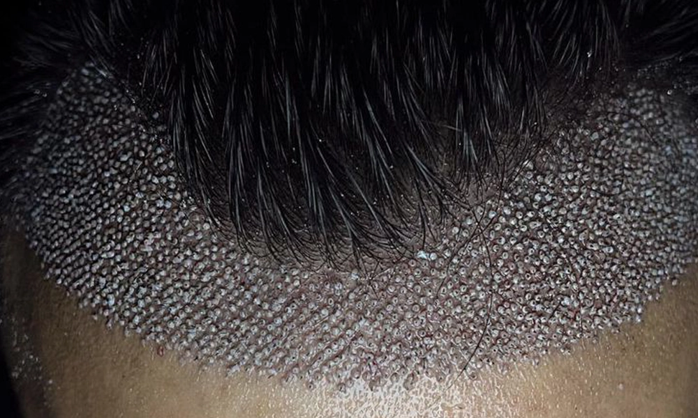 کاشت مو شقیقه و کمی هم در جلوی پیشانی